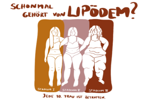 Read more about the article Diagnose Lipödem – was kannst du jetzt tun?